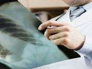 Francia: mujer murió de cáncer tras recibir trasplante de pulmones