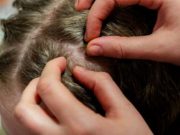 ¡Ojo, piojos! ¿Cuál es la mejor forma de eliminarlos?