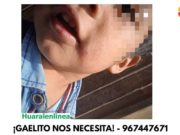 Huacho :Menor de 2 años sufre una enfermedad rara a la piel y necesita ayuda con urgencia