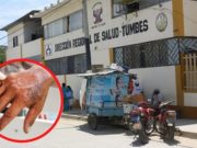 Tumbes: detectan el primer caso de lepra en extranjero proveniente de Brasil