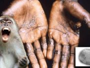 Se confirma el primer caso de la Viruela del Mono en Argentina