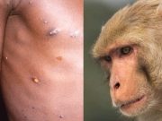 Se eleva a 44 los casos confirmados de viruela del mono en Alemania