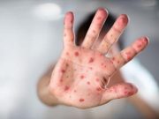 Primer caso del virus del mono en Perú ¿Cómo reconocer a un sospechoso y evitar el contagio?