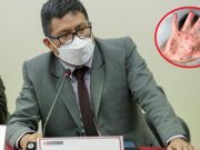 Más de 580 casos confirmados de la viruela del mono en 12 regiones del Perú