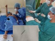 Iquitos: operan a menor de 7 años y extraen aguja de su hígado