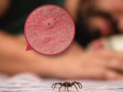 Especialista advierte: Cuidado con la picadura o mordedura de la araña casera