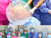Exitosa extracción de tumor de 17 kg en Hospital de Huaral Exitosa extracción de tumor de 17 kg en Hospital de Huaral