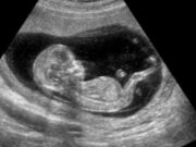 Bebé nació ‘embarazada’ del feto de su hermano, tuvo que someterse a una cesárea. Bebé nació ‘embarazada’ del feto de su hermano, tuvo que someterse a una cesárea.