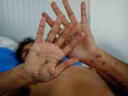 Viruela del mono: epidemiólogo de la UCV ofrece claves de protección en medio de la alerta global Viruela del mono epidemiólogo de la UCV ofrece claves de protección en medio de la alerta global